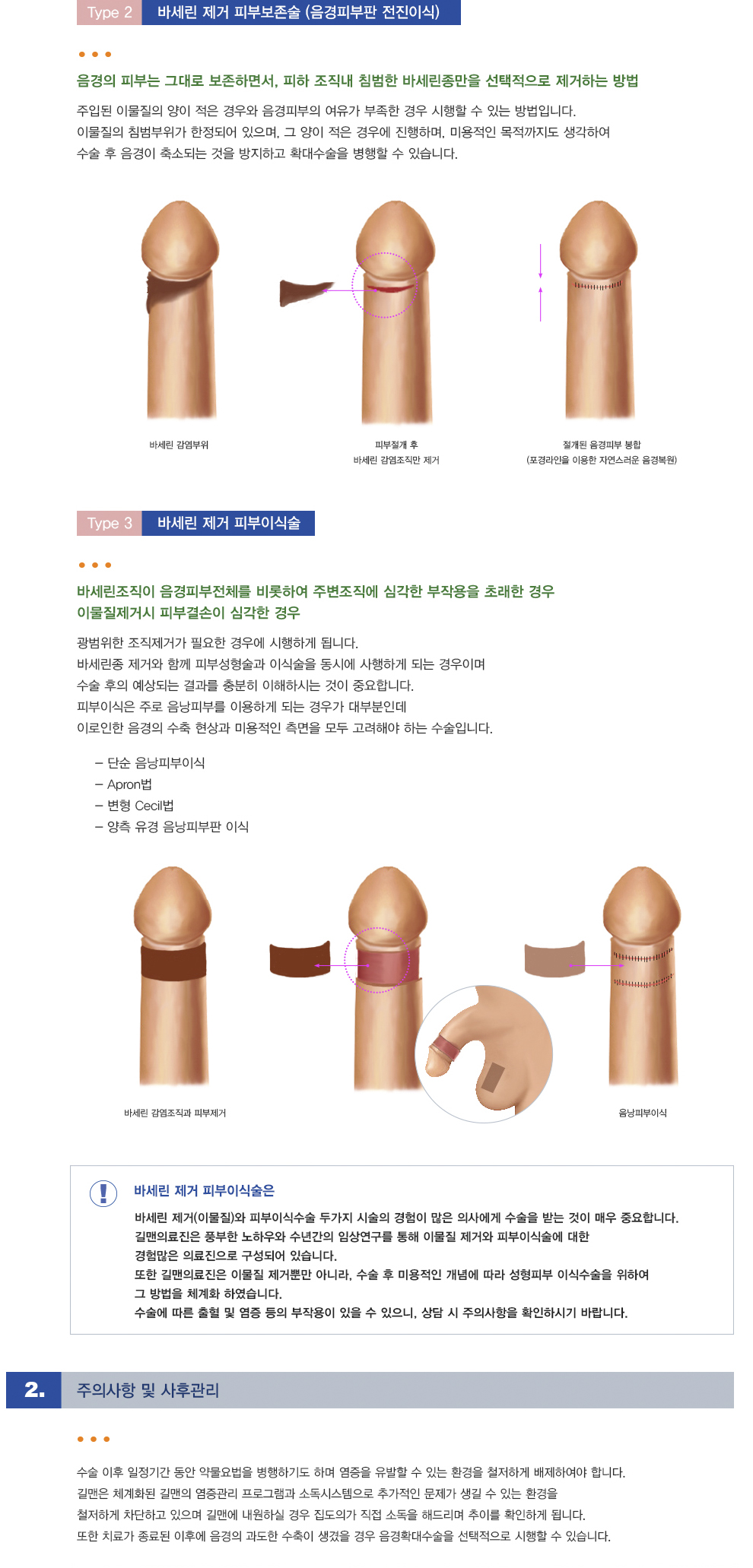바세린종 제거